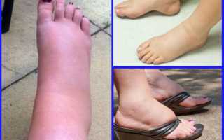 Как выбрать летнюю и осеннюю обувь, если отекают ноги?